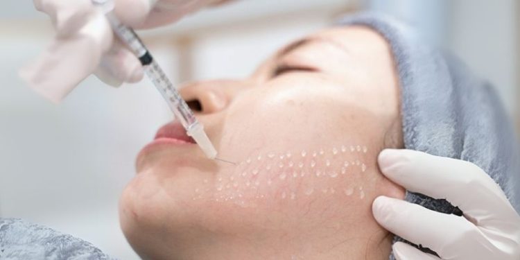 Meso Botox là gì: Giải pháp hoàn hảo để trẻ hóa làn da